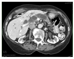 CT scan showing pancreatic cysts