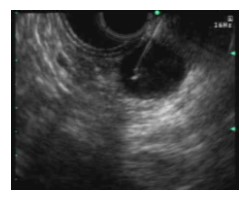 Fig 2. EUS with aspiration of cystic fluid 