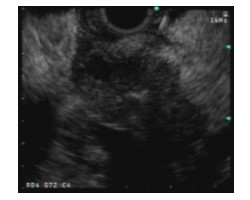 Fig 3, 4. EUS with fine needle biopsy of early pancreatic tumor missed on CT scan