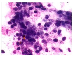 Fig 3, 4. EUS with fine needle biopsy of early pancreatic tumor missed on CT scan