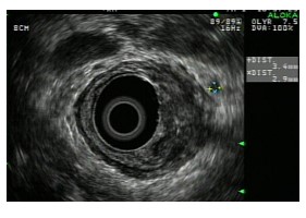 Fig 2. EUS shows tumor invasion through the muscularis propria wall layer of the rectum. A small malignant lymph node at 2 o&rsquo;clock position missed on PET/CT scan was also found on EUS. 