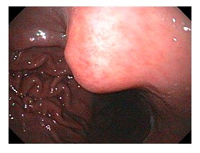 Fig 1. Gastric submucosal lesion on endoscopy 