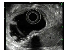 Fig 2. Liver granuloma pushing against stomach wall causing a &ldquo;bump&rdquo; seen on endoscopy